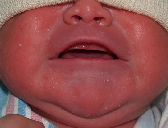 Por que a mancha branca aparece nos bebês?