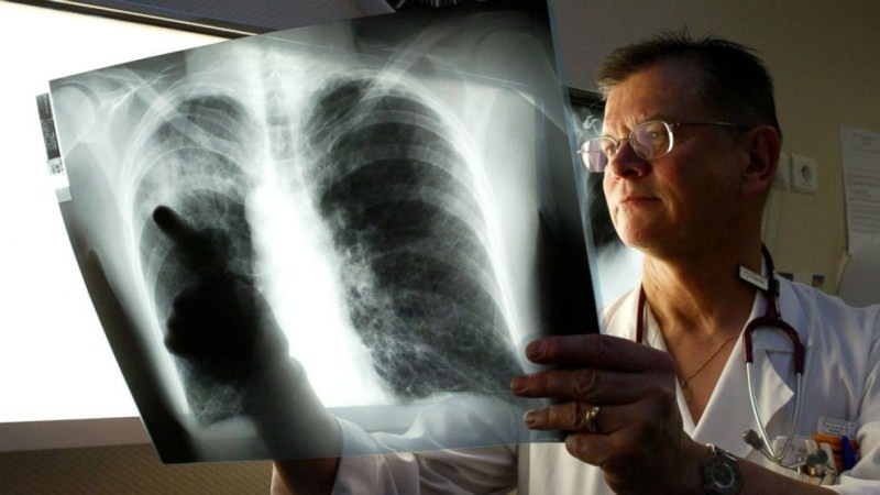 vírus legionário se instala nos pulmões 