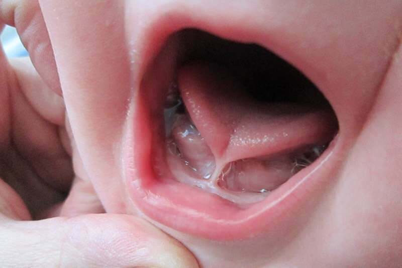 Sintomas e tratamento da ligação da língua em bebês