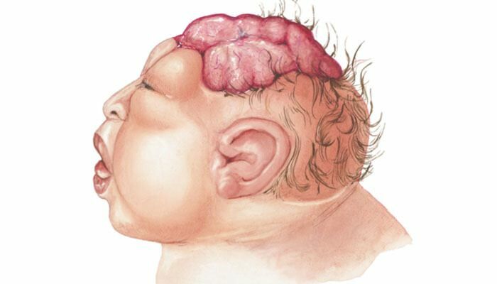 O que é anencefalia? Quais são os sintomas da anencefalia em bebês e crianças? A anencefalia causa ...