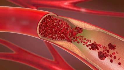 O que é anemia (anemia)? Fraqueza constante indica anemia! Alimentos que são bons para anemia ...