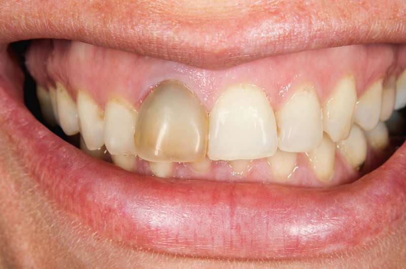 o escurecimento dos dentes às vezes pode se concentrar em um dente