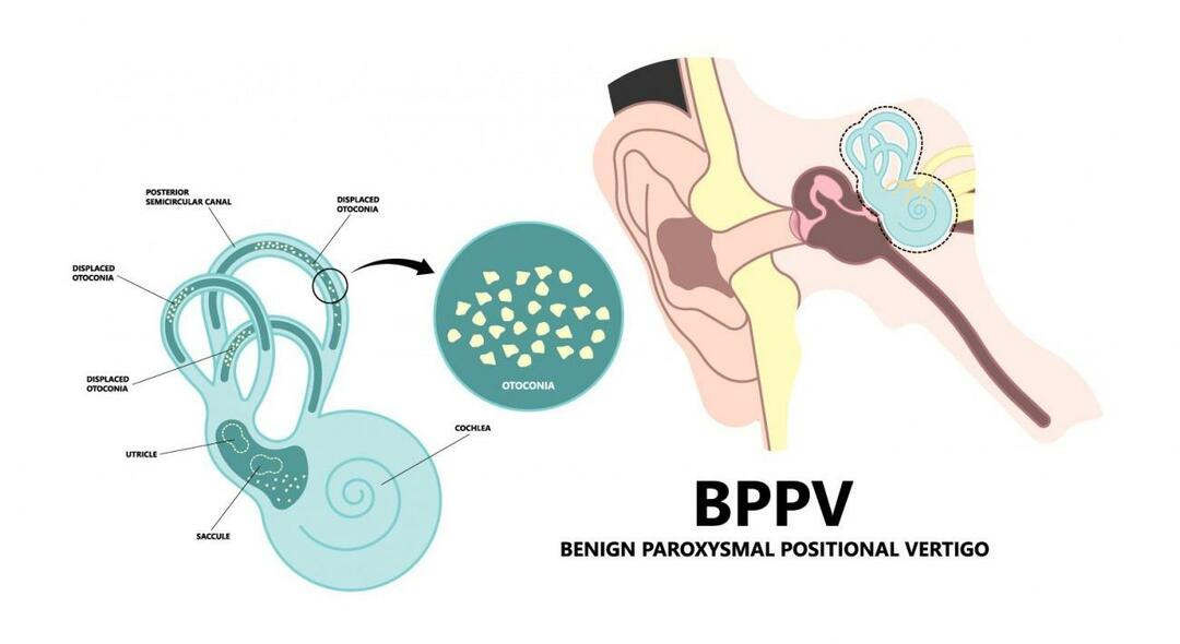 Por que a cabeça gira quando você está deitado? O que é bom para a vertigem posicional paroxística benigna? Como se livrar da VPPB