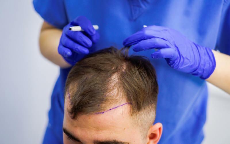 É permitido transplantar cabelo no tratamento da queda de cabelo? O que é cabelo protético? O cabelo protético atrapalha o ghusl?