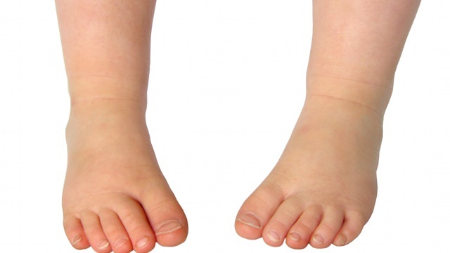 Os 3 problemas mais comuns na saúde dos pés