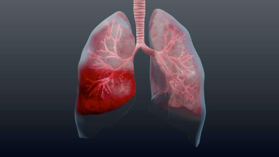 O que é pneumonia e quais são seus sintomas? Como é tratada a nova epidemia do vírus da pneumonia?