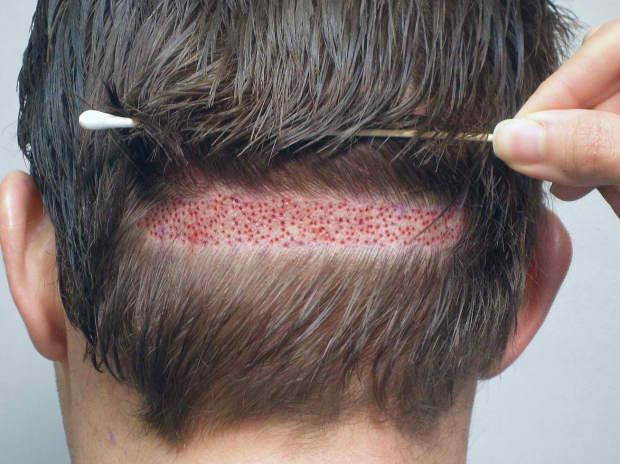 O que é Micose (Alopecia areata)? Quais são os sintomas da micose? Soluções eficazes para micose