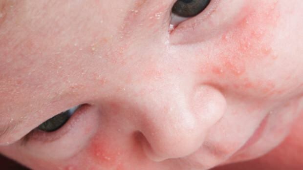 Como a acne passa nos bebês?