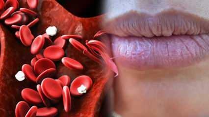 O que é anemia? A fraqueza constante é um sinal de anemia! Alimentos que são bons para anemia ...