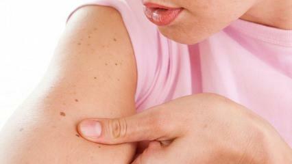 O que é câncer de pele (pele) e quais são seus sintomas? Formas de entender o câncer de pele