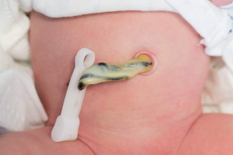 Quando o cordão umbilical cai em bebês?