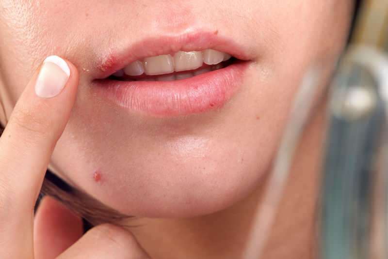 herpes geralmente sai na borda do lábio.