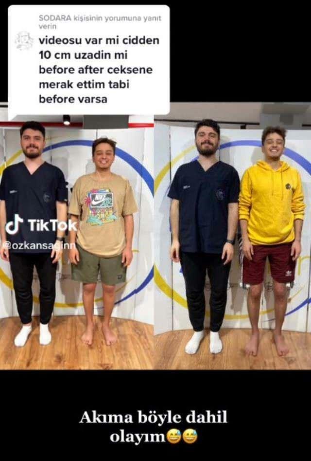 Özkan Sağın fez antes e depois da cirurgia