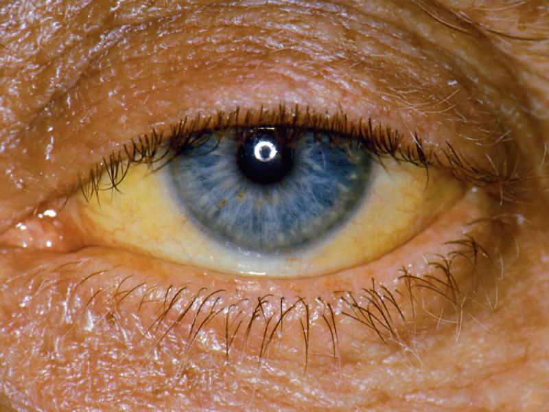 altura ao nível da bilirrubina causa coloração amarela nos olhos e na pele