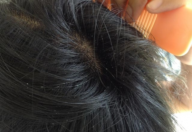 Por que acne no couro cabeludo