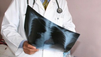 Anunciados especialistas! Aumento nas mortes por câncer de pulmão