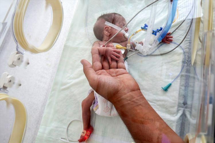 'Bebê milagroso' conseguiu sobreviver à cirurgia
