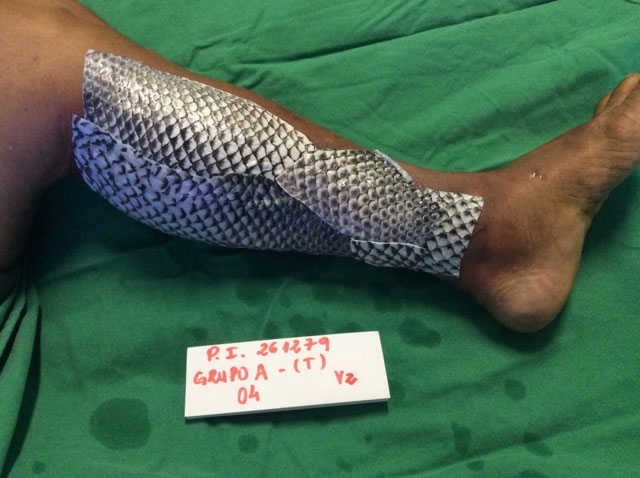 A pele de peixe passou para a história médica no tratamento de queimaduras