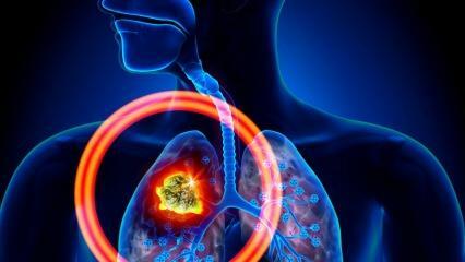 Quais são os sintomas do câncer de pulmão? Existe tratamento para o câncer de pulmão?