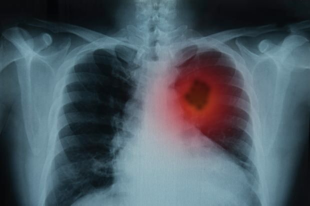 Existe tratamento para câncer de pulmão