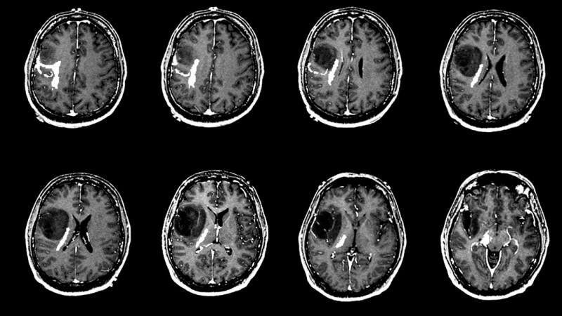 O que causa um tumor cerebral? Quais são os sintomas de um tumor cerebral? O tratamento do tumor cerebral é difícil?
