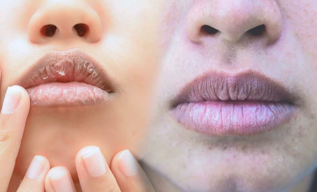 O que causa lábios escuros? Como o escurecimento labial ou hematomas são tratados?