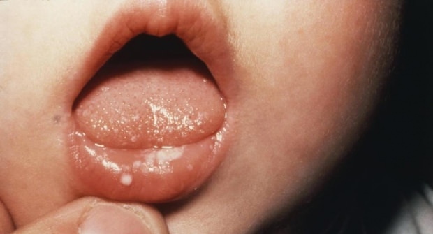 Como são feridas na boca em bebês