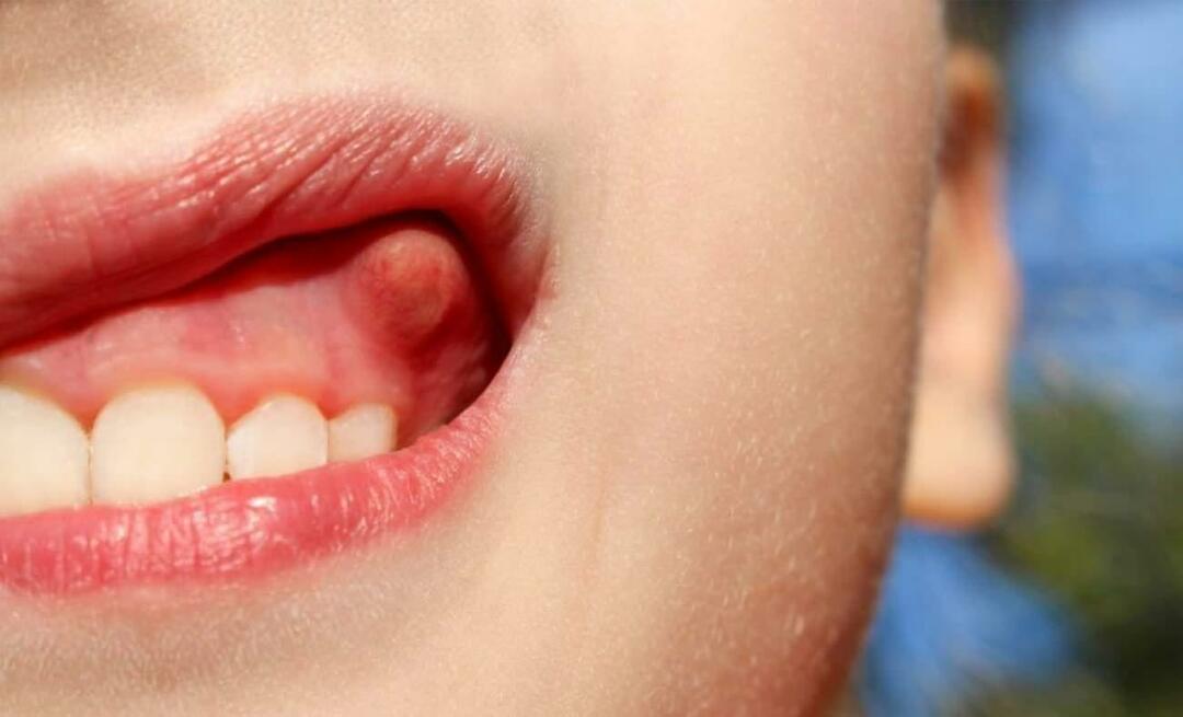 Por que o abscesso dentário e quais são os sintomas? Abscesso dentário, como é tratado?