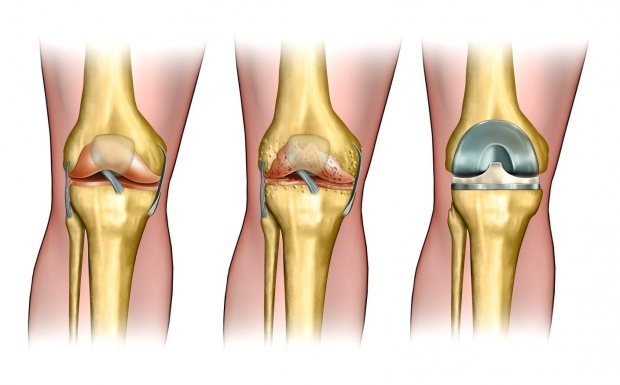 Doenças como artrite levam ao alívio da dor