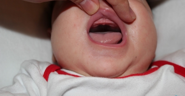 O que é queda palatina nos bebês, por quê? Sintomas e tratamento ...