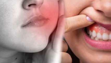 O que causa um abscesso dentário? Quais são os sintomas e em quantos dias? Soluções naturais para abscesso dentário...