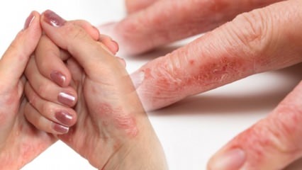 O que é eczema? Como é o eczema o mais fácil? A colônia causa eczema nas mãos? 