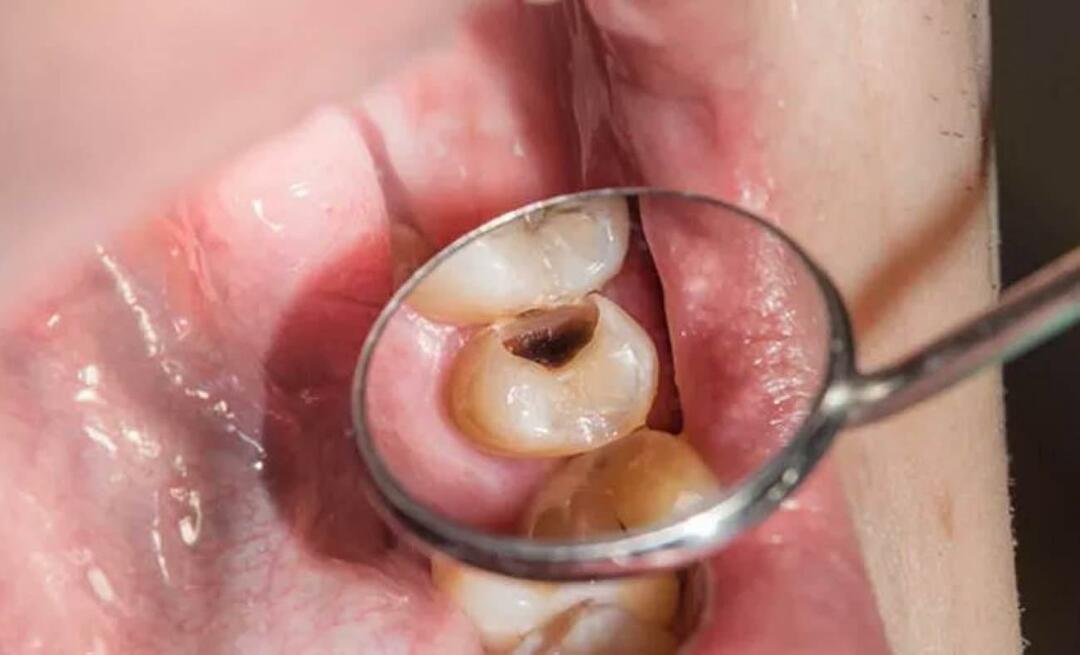 Por que os dentes apodrecem e o que podemos fazer para evitá-lo? 
