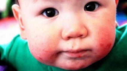 Como são as feridas na boca em bebês? O que é bom para feridas orais em bebês e crianças?