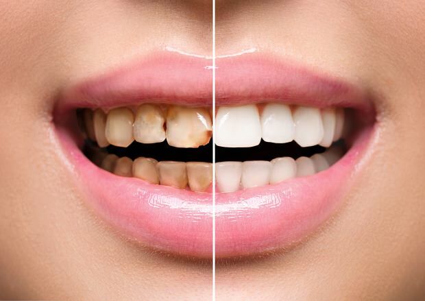 Como resultado de uma nutrição não saudável, ocorrem descoloração e perda dentária.