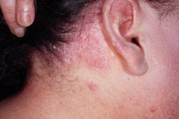 Quais são os sintomas da dermatite seborreica e quem aparece? Alimentos que desencadeiam a doença