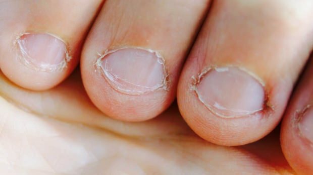 O que é a doença das unhas? Que doenças causa a ingestão de unhas?