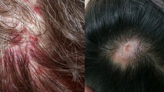 Por que a acne aparece no couro cabeludo