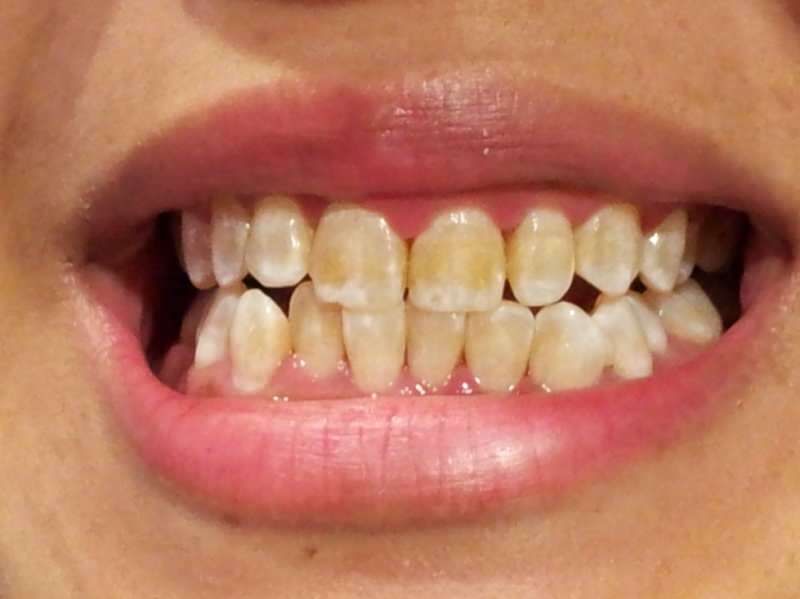 imagem dentária de uma pessoa cujos dentes começam a escurecer