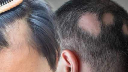 O que é Micose (Alopecia areata)? Quais são os sintomas da micose? Soluções eficazes para micose