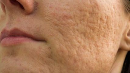 Como as cicatrizes de acne no rosto vão? Receitas de máscaras que removem cicatrizes de acne