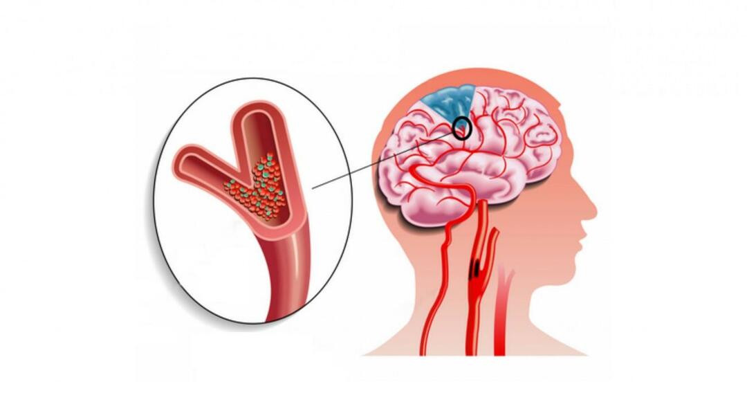 Desconforto nas pernas e braços: Embolia! O que é uma embolia? Quais são os sintomas da embolia?