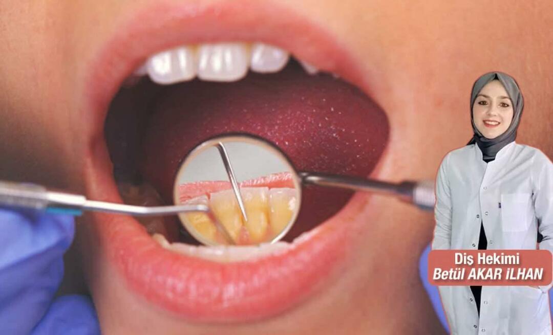 O que deve ser feito para evitar o tártaro? Quais são os benefícios da raspagem dentária?