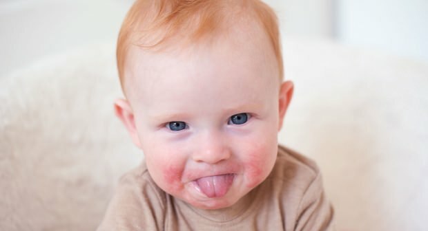Atenção em bebês com bochechas vermelhas! Síndrome da bochecha tapa e seus sintomas