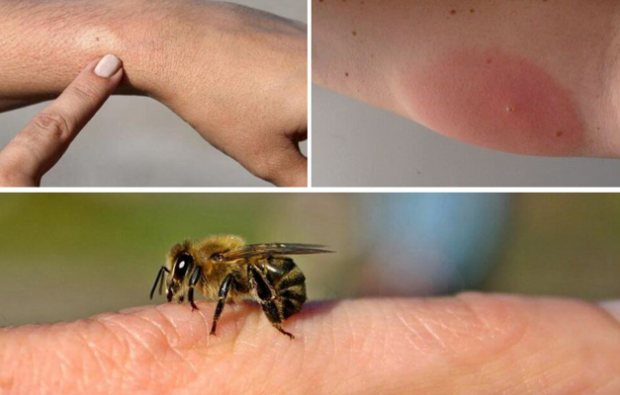 sintomas de alergia a abelhas