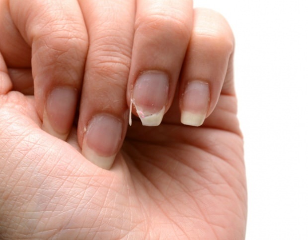 Como é feito o tratamento das unhas? Métodos de extensão rápida das unhas