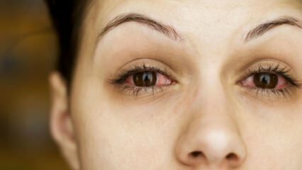 O que é conjuntivite (gripe ocular) e quais são os sintomas? Como a conjuntivite é transmitida?